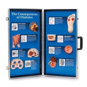3B Scientific The Consequences of Diabetes 3D Display