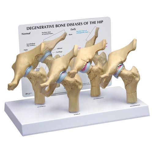 3B Scientific 4-Stage Degenerative Bone Diseases of the Hip Model