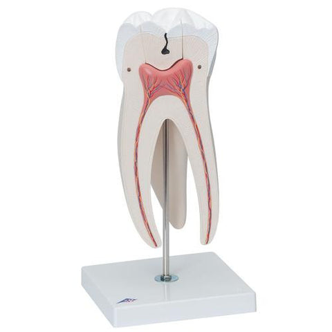 Image of 3B Scientific Giant Molar with Dental Cavities, 15 times life size, 5 part
