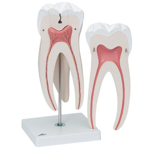 3B Scientific Giant Molar with Dental Cavities, 15 times life size, 5 part