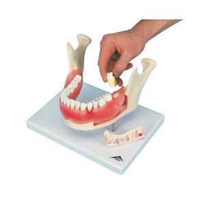 3B Scientific Dental disease, magnified 2 times, 21 parts