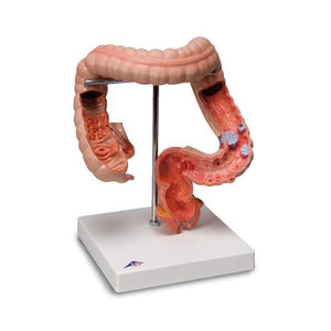 3B Scientific Intestinal diseases