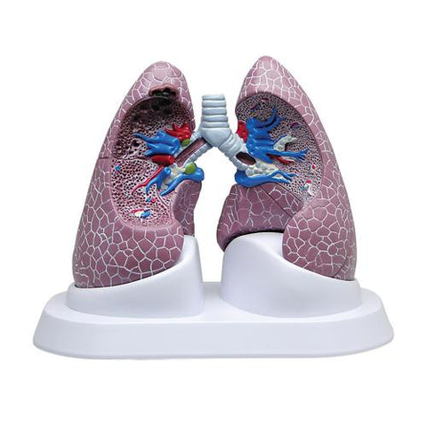 Image of 3B Scientific Lung Set with Pathologies