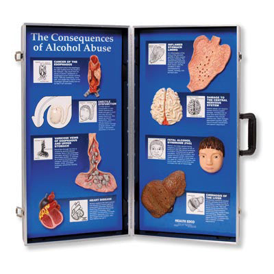 Image of 3B Scientific “Consequences of Alcoholism”, 3D Info Board