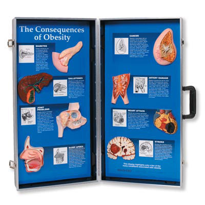 3B Scientific The Consequences of Obesity 3D Display