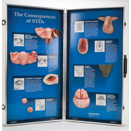 3B Scientific The Consequences of STDs -3D Display