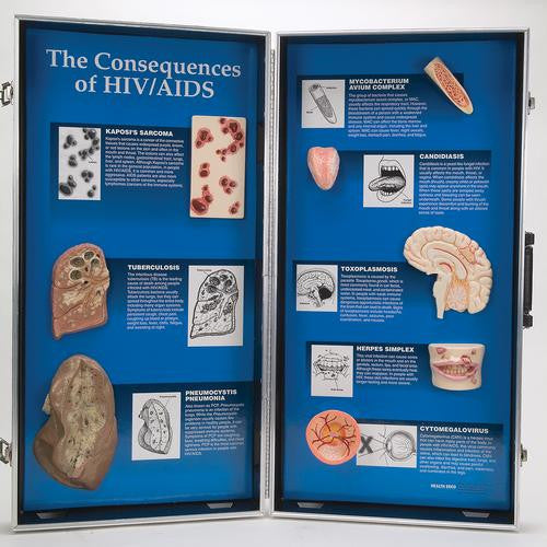 3B Scientific The Consequences of HIV/AIDS - 3D Display