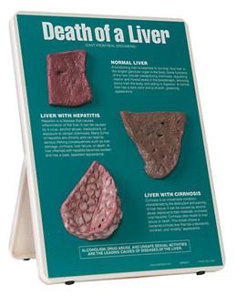 3B Scientific Death of a Liver Easel Display
