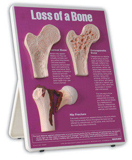 3B Scientific Loss of Bone Easel Display