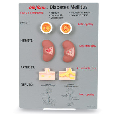 3B Scientific Life/form® Diabetes Mellitus Teaching Kit